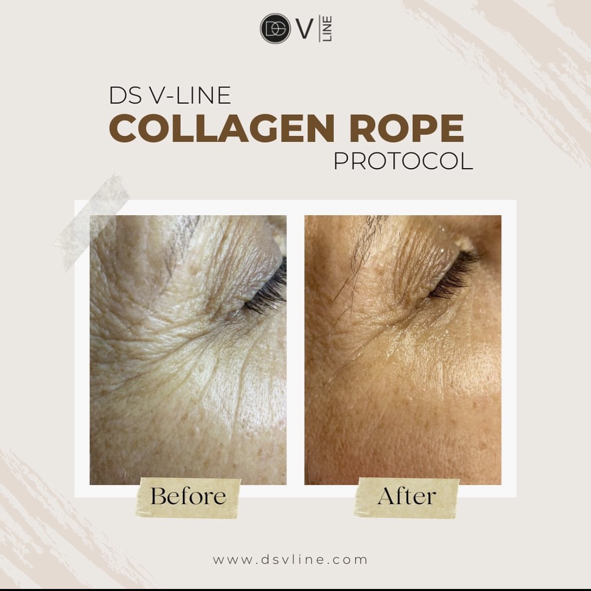 Collagen Rope Priser :: Anita`s hud og fotterapi